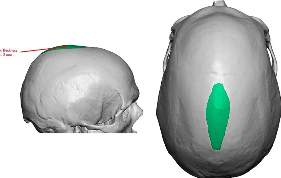 Sagittal crest reduction
