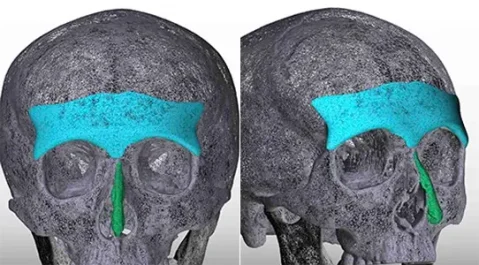 Custom 3d brow implant by Dr. Barry L. Eppley