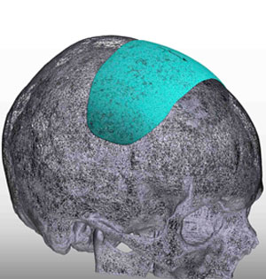 Custom sagittal dip skull implant design by Dr. Barry Eppley
