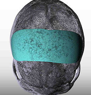 Custom sagittal dip skull implant design by Dr. Barry Eppley