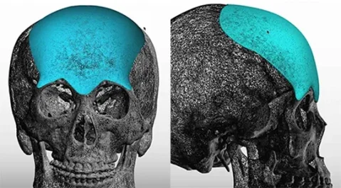 3d rendering of a custom forehead implant by Dr. Barry L. Eppley
