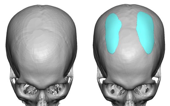 Custom skull reshaping design by Dr. Barry Eppley