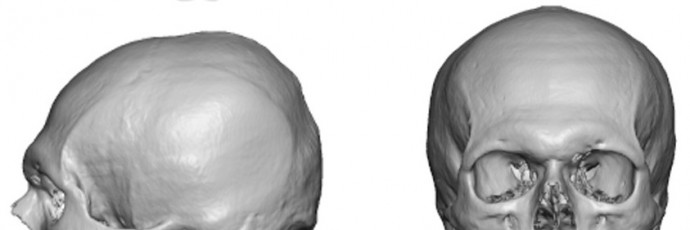 Lumpy Misshapen Skull Dr Barry Eppley Indianapolis
