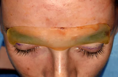 Custom brow bone implant by Dr. Eppley