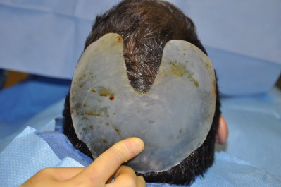 Skull reshaping