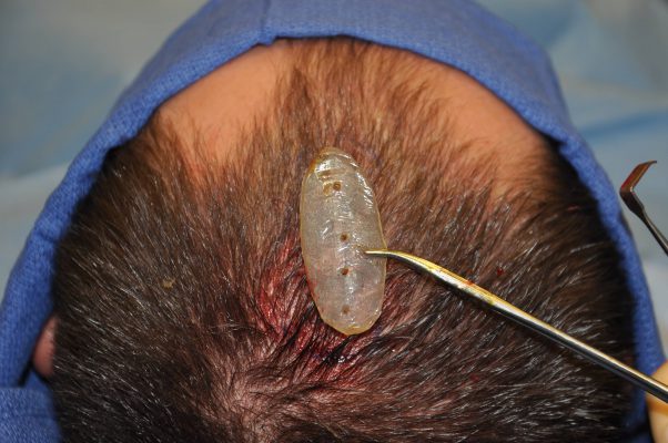 Skull Reshaping procedure