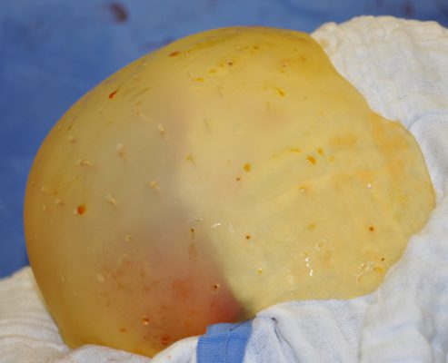 Custom skull implant