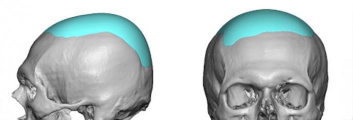 Thin Custom Skull Cap Implant design Dr Barry Eppley