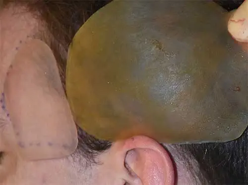 Total temporal augmentation