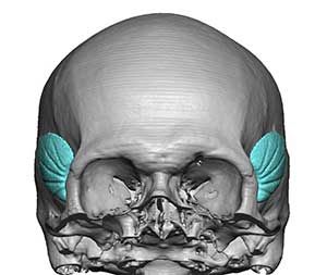 Standard Anterior Temporal Implants