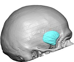 Standard Anterior Temporal Implants