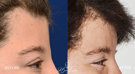 Female bone cement forehead augmentation by Dr. Barry Eppley