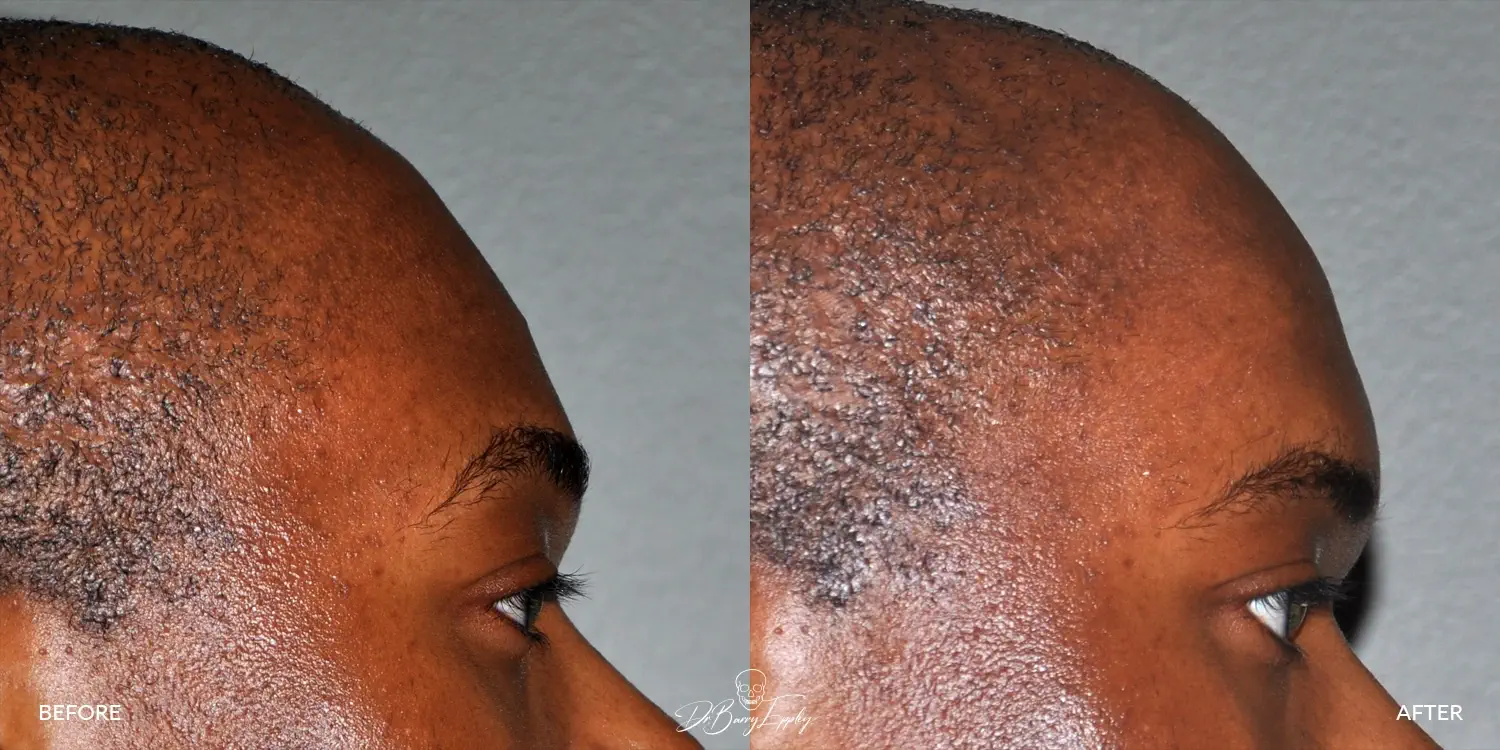 Before and after forehead augmentation by Dr. Eppley