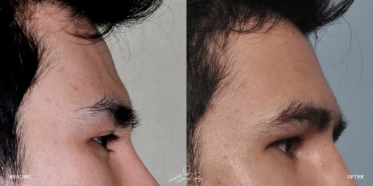 Before and after of male forehead augmentation, Dr. Barry Eppley