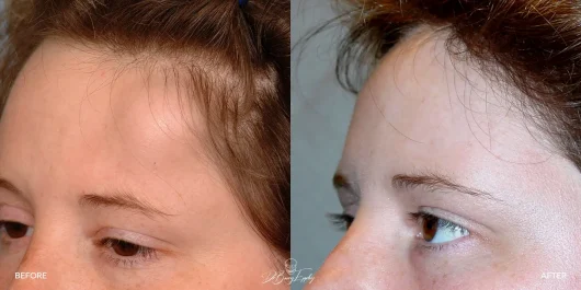 Forehead osteoma excision before and after photo by Dr. Barry L. Eppley