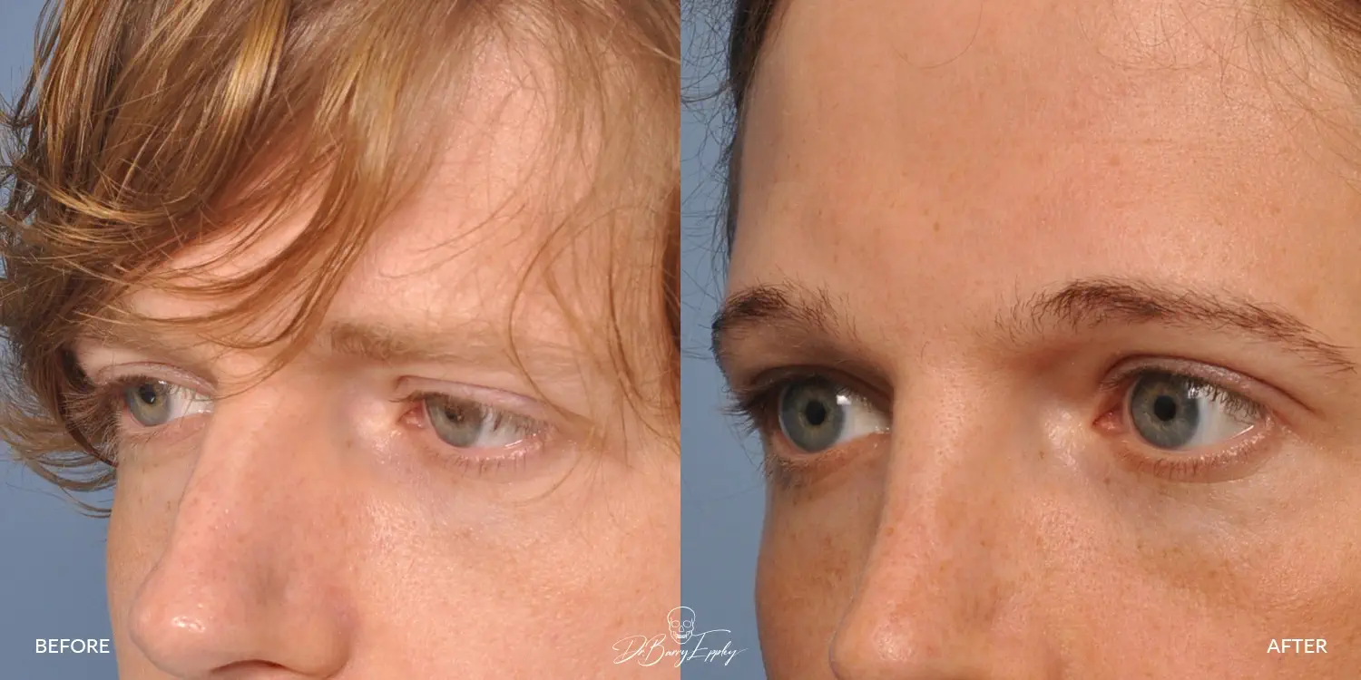 Forehead augmentation before and after photos by Dr. Barry Eppley