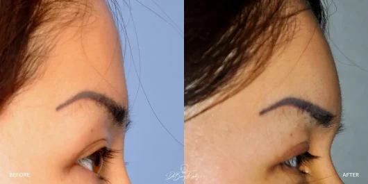 Brow bone augmentation by Dr. Barry L. Eppley