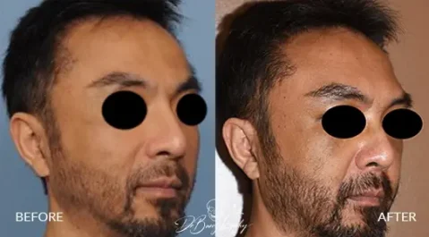 Before and after of custom brow bone implant by Dr. Barry Eppley