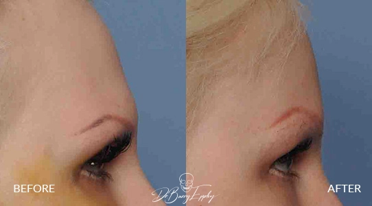 Before and after female brow bone burring by Dr. Barry Eppley