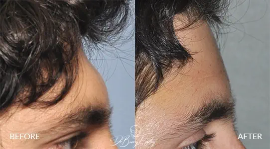 Side view before and after of male bone cement forehead augmentation by Dr. Barry L. Eppley