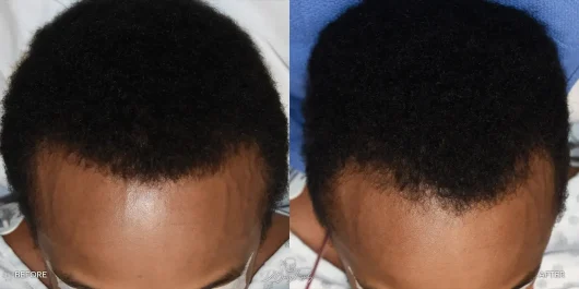 Male temporal reduction, before and after by Dr. Barry Eppley