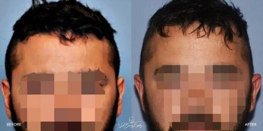 Male temporal reduction front, before and after by Dr. Barry Eppley