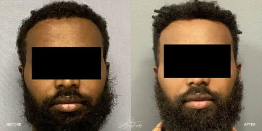 Male temporal reduction front, before and after by Dr. Barry Eppley