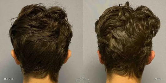 Back view before and after male temporal reduction