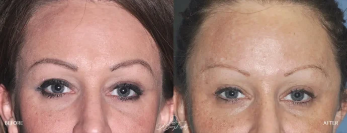 Before and after anterior temporal augmentation surgery by Dr. Barry L. Eppley