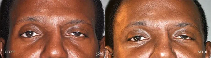 Before and after anterior temporal augmentation surgery by Dr. Barry L. Eppley