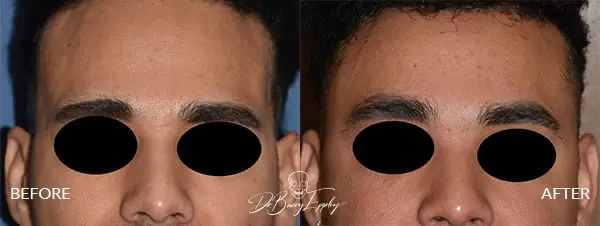Before and after non-hair bearing temporal augmentation surgery by Dr. Barry L. Eppley