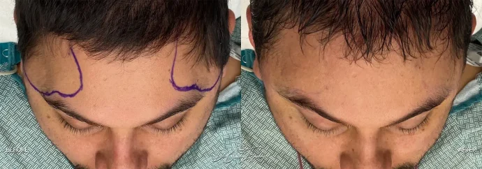 Before and after temporal forehead implant - Dr. Barry L. Eppley