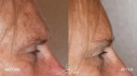 Transgender brow bone reduction before and after by Dr. Barry L. Eppley