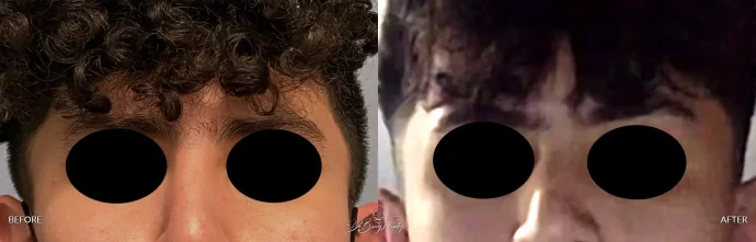 Before and after young male temporal reduction, front view - Dr. Barry L. Eppley