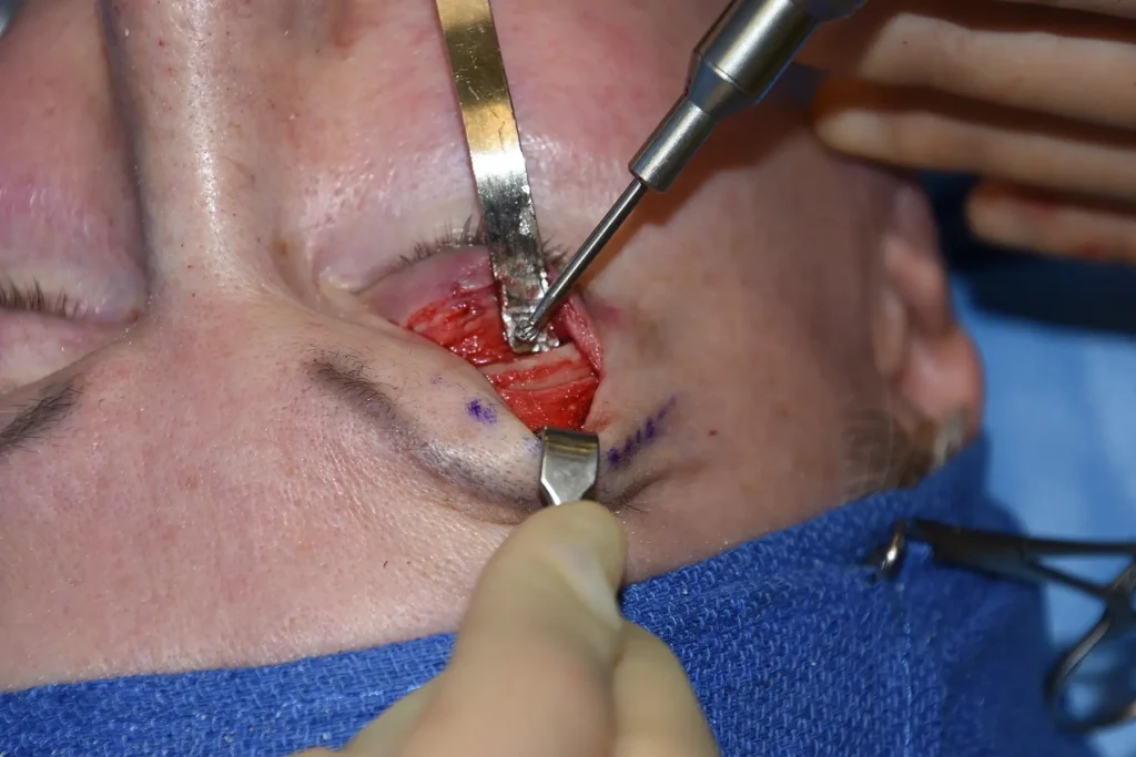 Brow bone reduction