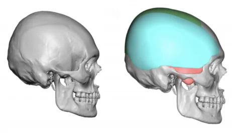 Before and after side view, 3d rendering of custom skull implant for narrow temples