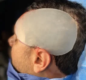 Custom extended temporal forehead impltant placed by Dr. Barry Eppley