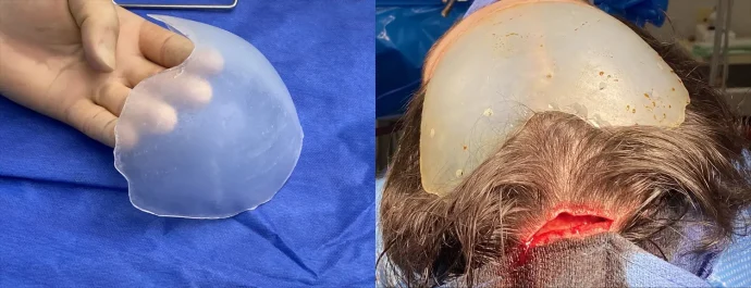 Custom forehead slope correction implant by Dr. Barry L. Eppley