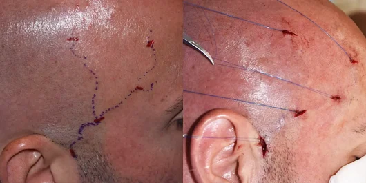 Temporal artery ligation