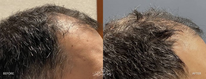 Mid sagittal crest skull deformity before and after by Dr. Barry Eppley