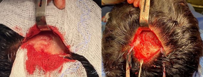 Dr. Barry Eppley performing skull augmentation surgery on a patient