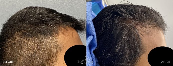 Skull reshaping before and after by Dr. Barry Eppley