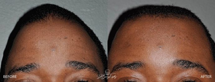 Skull reshaping before and after by Dr. Barry Eppley