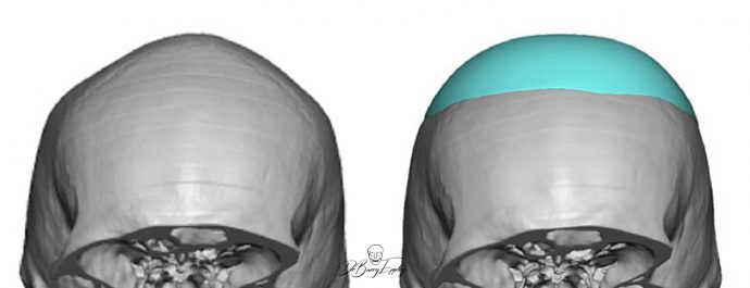 Custom skull implant design by Dr. Barry Eppley