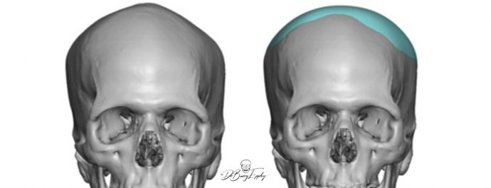 Custom skull implant design by Dr. Barry Eppley front view