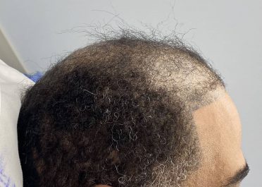 Sagittal ridge reduction by Dr. Barry Eppley