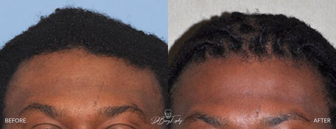Anterior sagittal ridge reduction before and after by Dr. Barry Eppley