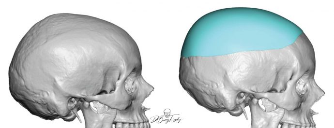 Custom skull implant design by Dr. Barry Eppley side view
