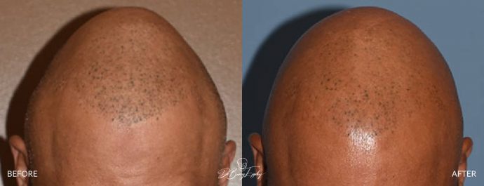 Parasagittal skull augmentation before and after by Dr. Barry Eppley