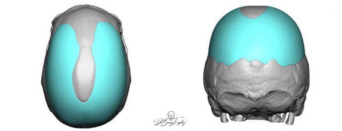 Custom parasagittal skull augmentation design top view